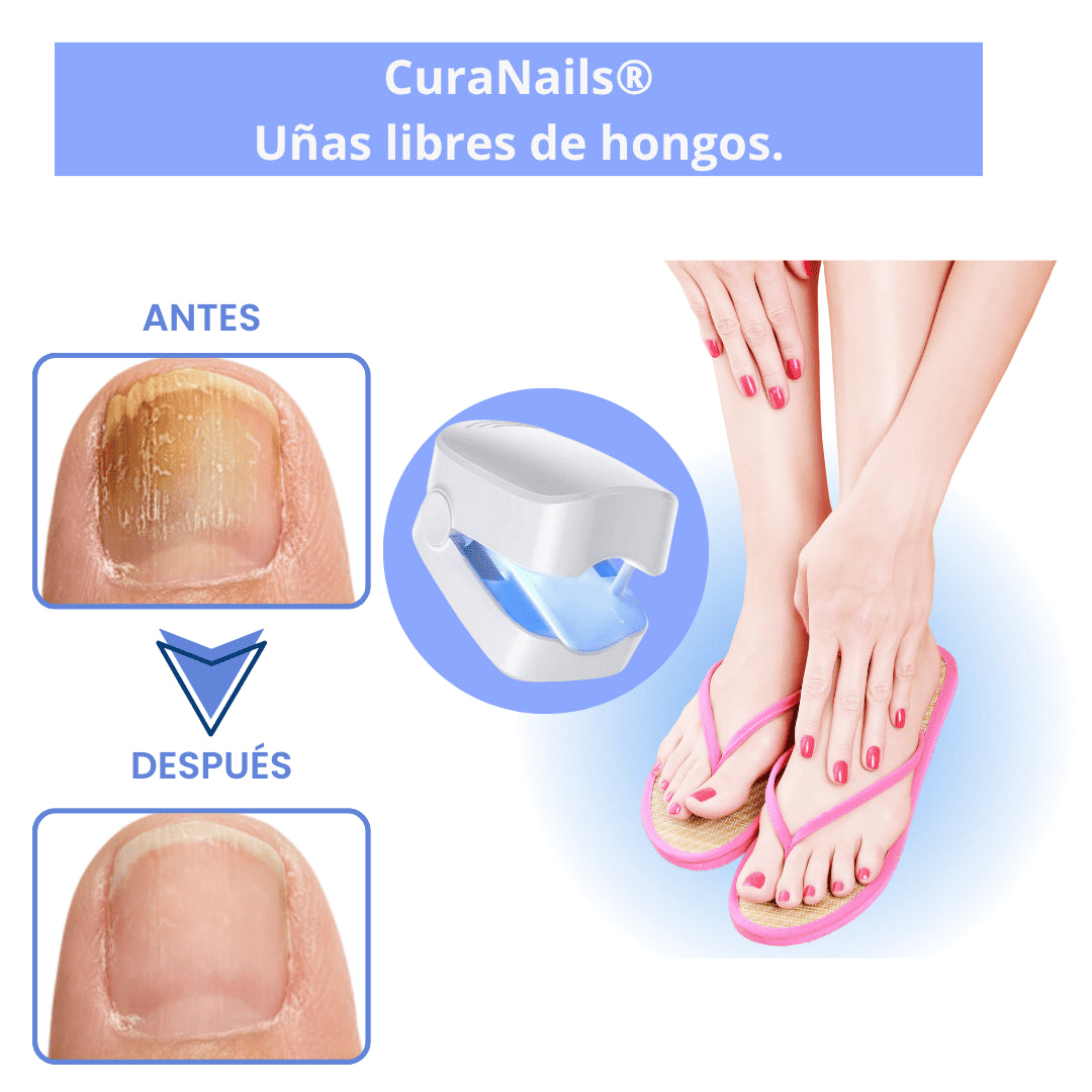 CuraNails®| Uñas libres de hongos.
